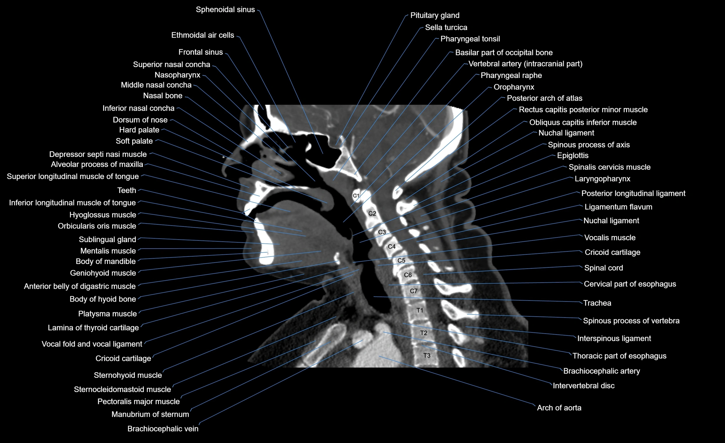 Neck CT sagittal cross sectional anatomy 3D  radiology  image-img-00001-00003.webp